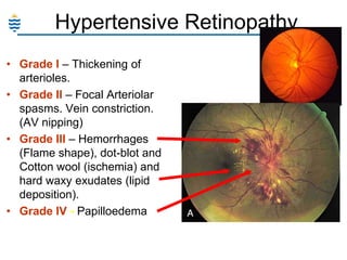 Hypertensive Retinopathy
• Grade I – Thickening of
arterioles.
• Grade II – Focal Arteriolar
spasms. Vein constriction.
(AV nipping)
• Grade III – Hemorrhages
(Flame shape), dot-blot and
Cotton wool (ischemia) and
hard waxy exudates (lipid
deposition).
• Grade IV - Papilloedema

 