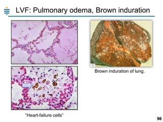 LVF: Pulmonary odema, Brown induration

Brown induration of lung.

―Heart-failure cells‖

96

 
