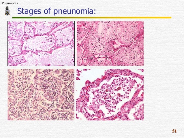 Pathology Review-Term1 lobar pneumonia diagram 