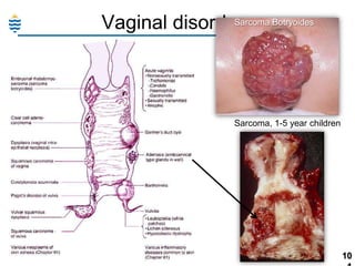 Sarcoma
Vaginal disorders: Botryoides

Sarcoma, 1-5 year children

10

 