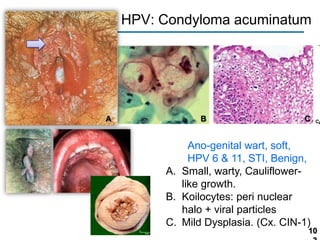 HPV: Condyloma acuminatum

A

B

C

Ano-genital wart, soft,
HPV 6 & 11, STI, Benign,
A. Small, warty, Cauliflowerlike growth.
B. Koilocytes: peri nuclear
halo + viral particles
C. Mild Dysplasia. (Cx. CIN-1)

10

 