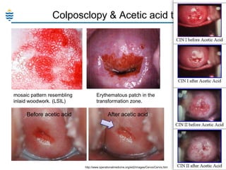 Colposclopy & Acetic acid test

mosaic pattern resembling
inlaid woodwork. (LSIL)

Before acetic acid

Erythematous patch in the
transformation zone.

After acetic acid

http://www.operationalmedicine.org/ed2/images/Cervix/Cervix.htm

10

 