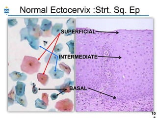 Normal Ectocervix :Strt. Sq. Ep
SUPERFICIAL

INTERMEDIATE

BASAL

10

 
