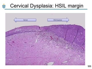 Cervical Dysplasia: HSIL margin
Normal

HSIL/Dysplasia

111

 