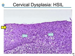 Cervical Dysplasia: HSIL

?

11

 