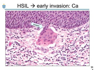 HSIL  early invasion: Ca

11

 