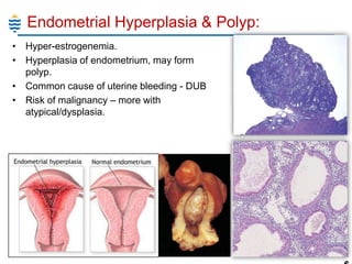 Endometrial Hyperplasia & Polyp:
• Hyper-estrogenemia.
• Hyperplasia of endometrium, may form
polyp.
• Common cause of uterine bleeding - DUB
• Risk of malignancy – more with
atypical/dysplasia.

11

 