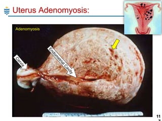 Uterus Adenomyosis:
Adenomyosis

11

 
