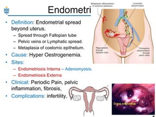 Endometriosis:
• Definition: Endometrial spread
beyond uterus.
– Spread through Fallopian tube
– Pelvic veins or Lymphatic spread.
– Metaplasia of coelomic epithelium.

• Cause: Hyper Oestrogenemia.
• Sites:
– Endometriosis Interna – Adenomyosis.
– Endometriosis Externa

• Clinical: Periodic Pain, pelvic
inflammation, fibrosis,
• Complications: infertility,
11

 