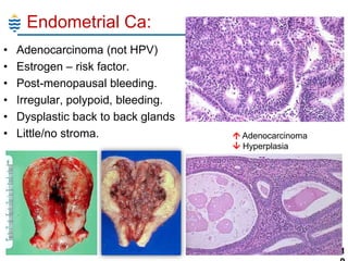 Endometrial Ca:
•
•
•
•
•
•

Adenocarcinoma (not HPV)
Estrogen – risk factor.
Post-menopausal bleeding.
Irregular, polypoid, bleeding.
Dysplastic back to back glands
Little/no stroma.

 Adenocarcinoma
 Hyperplasia

11

 