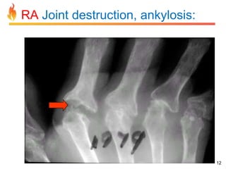 RA Joint destruction, ankylosis:

12

 
