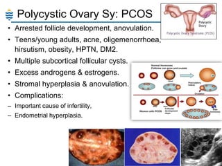 Polycystic Ovary Sy: PCOS
• Arrested follicle development, anovulation.
• Teens/young adults, acne, oligemenorrhoea,
hirsutism, obesity, HPTN, DM2.

• Multiple subcortical follicular cysts.
• Excess androgens & estrogens.
• Stromal hyperplasia & anovulation.

• Complications:
– Important cause of infertility,
– Endometrial hyperplasia.

12

 