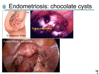 Endometriosis: chocolate cysts

Frozen Pelvis - adhesions

12

 