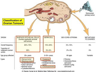 Classification of
Ovarian Tumours

12

 