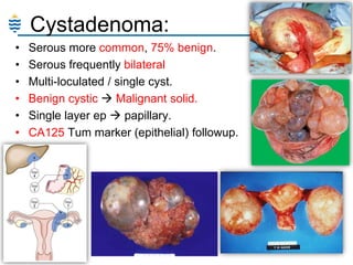 Cystadenoma:
•
•
•
•
•
•

Serous more common, 75% benign.
Serous frequently bilateral
Multi-loculated / single cyst.
Benign cystic  Malignant solid.
Single layer ep  papillary.
CA125 Tum marker (epithelial) followup.

 