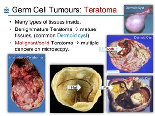 Germ Cell Tumours: Teratoma
• Many types of tissues inside.
• Benign/mature Teratoma  mature
tissues. (common Dermoid cyst)
• Malignant/solid Teratoma  multiple
cancers on microscopy.

Dermoid Cyst

Dermoid Cyst

Tooth..!

Immature Teratoma

Dermoid Cyst

Hair

128

Fat

 