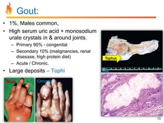Gout:
• 1%, Males common,
• High serum uric acid + monosodium
urate crystals in & around joints.
– Primary 90% - congenital
– Secondary 10% (malignancies, renal
disesase, high protein diet)
– Acute / Chronic.

Tophus

• Large deposits – Tophi
Acute

Chronic

13

 