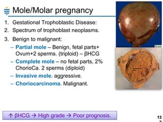 Mole/Molar pregnancy
1. Gestational Trophoblastic Disease:
2. Spectrum of trophoblast neoplasms.
3. Benign to malignant:
– Partial mole – Benign, fetal parts+
Ovum+2 sperms. (triploid) – βHCG
– Complete mole – no fetal parts, 2%
ChorioCa. 2 sperms (diploid)
– Invasive mole. aggressive.
– Choriocarcinoma. Malignant.

 βHCG  High grade  Poor prognosis.

13

 