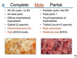 Complete
• All villi cystic, no BV
• No fetal parts
• Diffuse trophoblastic
hyperplasia
• Diploid (2 sperms)
• Choriocarcinoma 2%
• High βHCG levels.

Mole

Partial

• Partially cystic, few BV.
• Fetal parts +
• Focal hyperplasia of
trophoblasts
• Triploid (ovum+2 sperms)
• Rare carcinoma
• Relatively less βHCG.

13

 