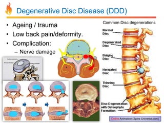 Degenerative Disc Disease (DDD)
• Ageing / trauma
• Low back pain/deformity.
• Complication:

Common Disc degenerations

– Nerve damage

Online Animation (Spine Universe.com)

 