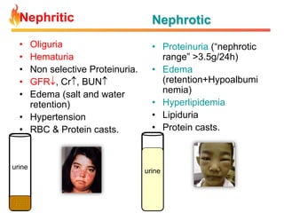 Nephritic

Nephrotic

•
•
•
•
•

• Proteinuria (“nephrotic
range” >3.5g/24h)
• Edema
(retention+Hypoalbumi
nemia)
• Hyperlipidemia
• Lipiduria
• Protein casts.

Oliguria
Hematuria
Non selective Proteinuria.
GFR , Cr , BUN
Edema (salt and water
retention)
• Hypertension
• RBC & Protein casts.

urine

urine

 