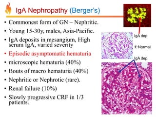 IgA Nephropathy (Berger’s)
• Commonest form of GN – Nephritic.
• Young 15-30y, males, Asia-Pacific.
• IgA deposits in mesangium, High
serum IgA, varied severity
• Episodic asymptomatic hematuria
• microscopic hematuria (40%)
• Bouts of macro hematuria (40%)
• Nephritic or Nephrotic (rare).
• Renal failure (10%)
• Slowly progressive CRF in 1/3
patients.

IgA dep.
Normal
IgA dep.

 