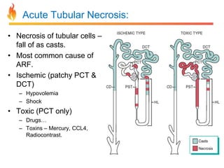 Acute Tubular Necrosis:
• Necrosis of tubular cells –
fall of as casts.
• Most common cause of
ARF.
• Ischemic (patchy PCT &
DCT)
– Hypovolemia
– Shock

• Toxic (PCT only)
– Drugs…
– Toxins – Mercury, CCL4,
Radiocontrast.

 