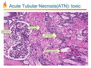 Acute Tubular Necrosis(ATN): toxic

Necrotic PCT
(no nuclei)
Glom. Norm
Normal DCT
(Pro. cast inside)

PCT early necrosis

 