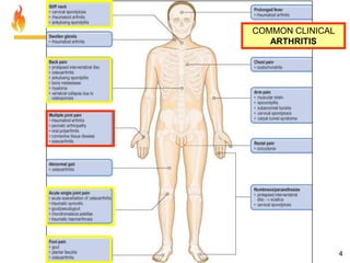 COMMON CLINICAL
ARTHRITIS

4

 