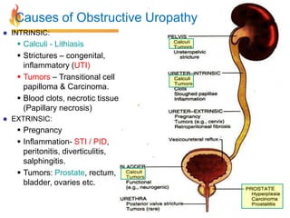 Causes of Obstructive Uropathy


INTRINSIC:

 Calculi - Lithiasis
 Strictures – congenital,
inflammatory (UTI)
 Tumors – Transitional cell
papilloma & Carcinoma.
 Blood clots, necrotic tissue
(Papillary necrosis)


EXTRINSIC:

 Pregnancy
 Inflammation- STI / PID,
peritonitis, diverticulitis,
salphingitis.
 Tumors: Prostate, rectum,
bladder, ovaries etc.

 