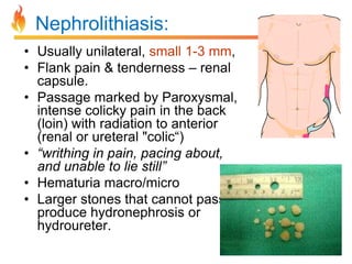 Nephrolithiasis:
• Usually unilateral, small 1-3 mm,
• Flank pain & tenderness – renal
capsule.
• Passage marked by Paroxysmal,
intense colicky pain in the back
(loin) with radiation to anterior
(renal or ureteral "colic“)
• “writhing in pain, pacing about,
and unable to lie still”
• Hematuria macro/micro
• Larger stones that cannot pass
produce hydronephrosis or
hydroureter.

 