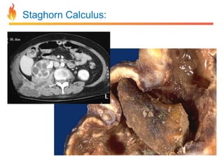 Staghorn Calculus:

 