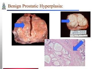 Benign Prostatic Hyperplasia:

 