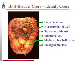BPH-Bladder Gross – Identify Cues?









Trabeculations
Hypertrophy of wall
Stone - urolithiasis
Inflammation
Median lobe- ball valve.
Enlarged prostate.

 