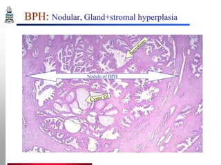 BPH: Nodular, Gland+stromal hyperplasia

Nodule of BPH

 