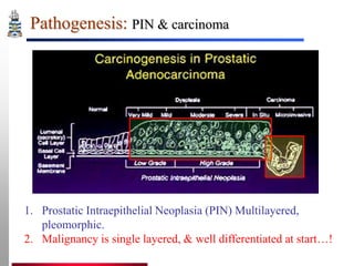 Pathogenesis: PIN & carcinoma

1. Prostatic Intraepithelial Neoplasia (PIN) Multilayered,
pleomorphic.
2. Malignancy is single layered, & well differentiated at start…!

 