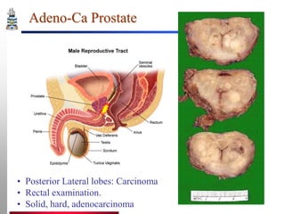 Adeno-Ca Prostate

• Posterior Lateral lobes: Carcinoma
• Rectal examination.
• Solid, hard, adenocarcinoma

 