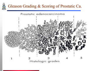 Gleason Grading & Scoring of Prostatic Ca.

 