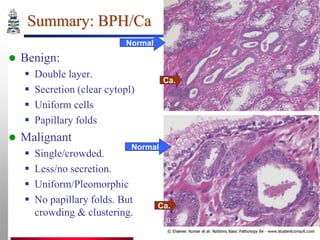 Summary: BPH/Ca
Normal



Benign:







Double layer.
Secretion (clear cytopl)
Uniform cells
Papillary folds

Ca.

Malignant





Normal

Single/crowded.
Less/no secretion.
Uniform/Pleomorphic
No papillary folds. But
crowding & clustering.

Ca.

 
