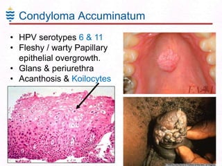 Condyloma Accuminatum
• HPV serotypes 6 & 11
• Fleshy / warty Papillary
epithelial overgrowth.
• Glans & periurethra
• Acanthosis & Koilocytes

 