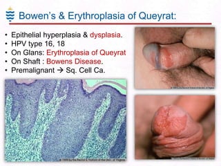 Bowen’s & Erythroplasia of Queyrat:
•
•
•
•
•

Epithelial hyperplasia & dysplasia.
HPV type 16, 18
On Glans: Erythroplasia of Queyrat
On Shaft : Bowens Disease.
Premalignant  Sq. Cell Ca.

 