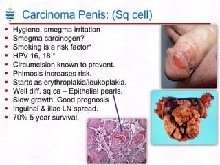 Carcinoma Penis: (Sq cell)












Hygiene, smegma irritation
Smegma carcinogen?
Smoking is a risk factor*
HPV 16, 18 *
Circumcision known to prevent.
Phimosis increases risk.
Starts as erythroplakia/leukoplakia.
Well diff. sq.ca – Epithelial pearls.
Slow growth, Good prognosis
Inguinal & iliac LN spread.
70% 5 year survival.

 