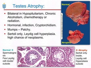 Testes Atrophy:

Normal

 Bilateral in Hypopituitarism, Chronic
Alcoholism, chemotherapy or
radiation.
 Hormonal, infection, Cryptorchidism.
 Mumps – Patchy.
 Sertoli only, Leydig cell hyperplasia.
high chance of neoplasms.
Atrophic
Normal 
Spermatogne
sis
Few Leydig
cell cluster
outside

 Atrophy
Sertoli only
inside,
Leydig cell
Hyperplasia
outside

 