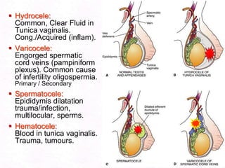  Hydrocele:
Common, Clear Fluid in
Tunica vaginalis.
Cong./Acquired (inflam).
 Varicocele:
Engorged spermatic
cord veins (pampiniform
plexus). Common cause
of infertility oligospermia.
Primary / Secondary

 Spermatocele:
Epididymis dilatation
trauma/infection,
multilocular, sperms.
 Hematocele:
Blood in tunica vaginalis.
Trauma, tumours.

 