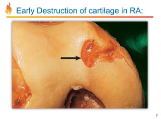 Early Destruction of cartilage in RA:

7

 