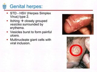 Genital herpes:
 STD - HSV (Herpes Simplex
Virus) type 2.
 Itching  closely grouped
vesicles surrounded by
erythema.
 Vesicles burst to form painful
ulcers.
 Multinucleate giant cells with
viral inclusion.

 