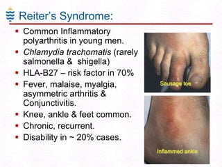 Reiter’s Syndrome:
 Common Inflammatory
polyarthritis in young men.
 Chlamydia trachomatis (rarely
salmonella & shigella)
 HLA-B27 – risk factor in 70%
 Fever, malaise, myalgia,
asymmetric arthritis &
Conjunctivitis.
 Knee, ankle & feet common.
 Chronic, recurrent.
 Disability in ~ 20% cases.

Sausage toe

Inflammed ankle

 