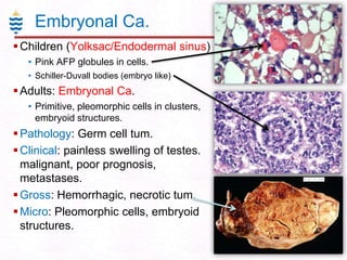 Embryonal Ca.
 Children (Yolksac/Endodermal sinus)
• Pink AFP globules in cells.
• Schiller-Duvall bodies (embryo like)

 Adults: Embryonal Ca.
• Primitive, pleomorphic cells in clusters,
embryoid structures.

 Pathology: Germ cell tum.
 Clinical: painless swelling of testes.
malignant, poor prognosis,
metastases.
 Gross: Hemorrhagic, necrotic tum.
 Micro: Pleomorphic cells, embryoid
structures.

 