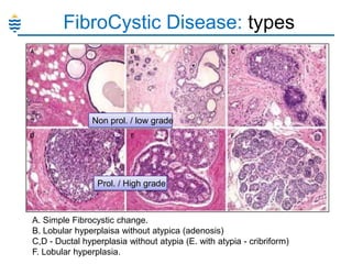 FibroCystic Disease: types

Non prol. / low grade

Prol. / High grade

A. Simple Fibrocystic change.
B. Lobular hyperplaisa without atypica (adenosis)
C,D - Ductal hyperplasia without atypia (E. with atypia - cribriform)
F. Lobular hyperplasia.

 