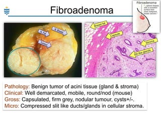 Fibroadenoma

Pathology: Benign tumor of acini tissue (gland & stroma)
Clinical: Well demarcated, mobile, round/nod (mouse)
Gross: Capsulated, firm grey, nodular tumour, cysts+/-.
Micro: Compressed slit like ducts/glands in cellular stroma.

 